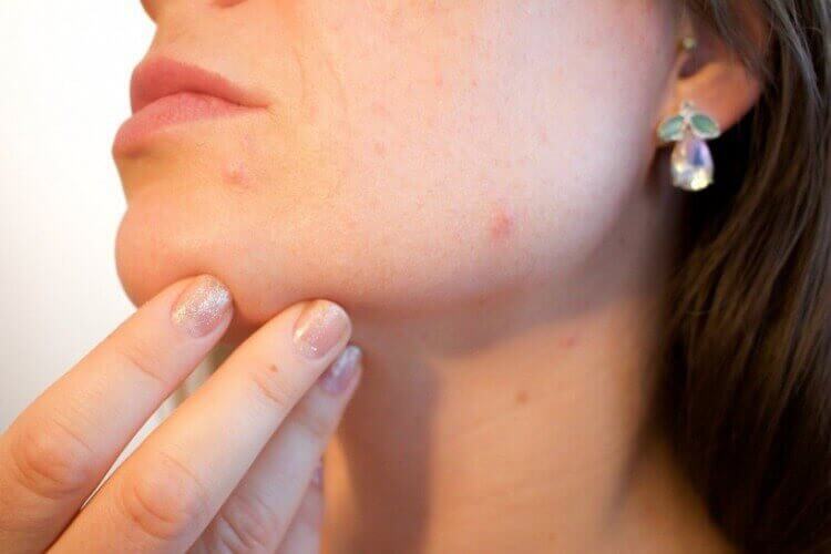 Actual Observations You Need to  Know About "Fade Acne Scars Fast"  Treatments