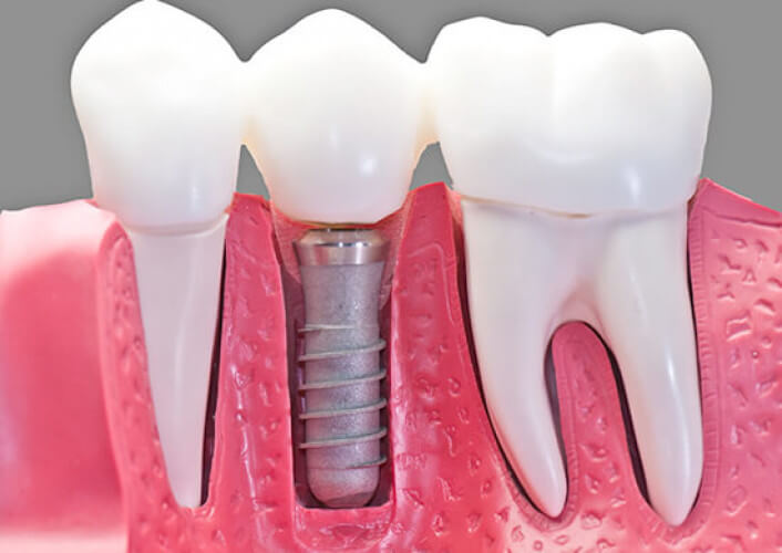 Permanent Dental Implants: A Comfortable Option for Missing Teeth.